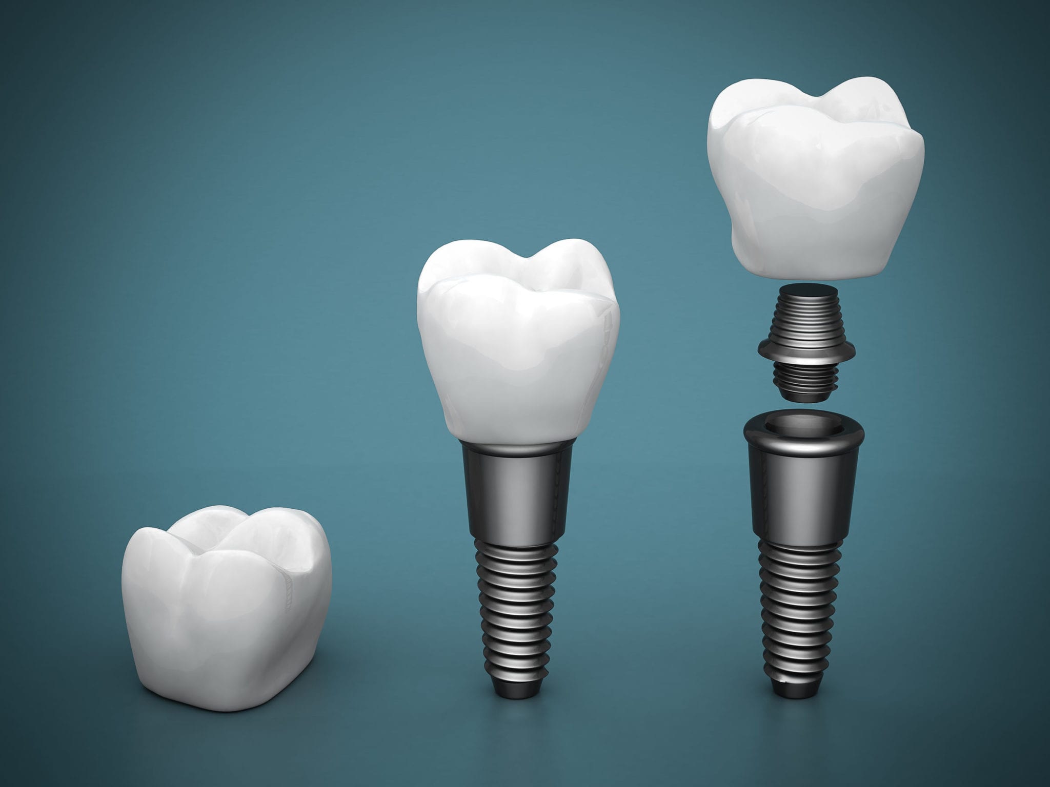 Different Types Of Dental Implants