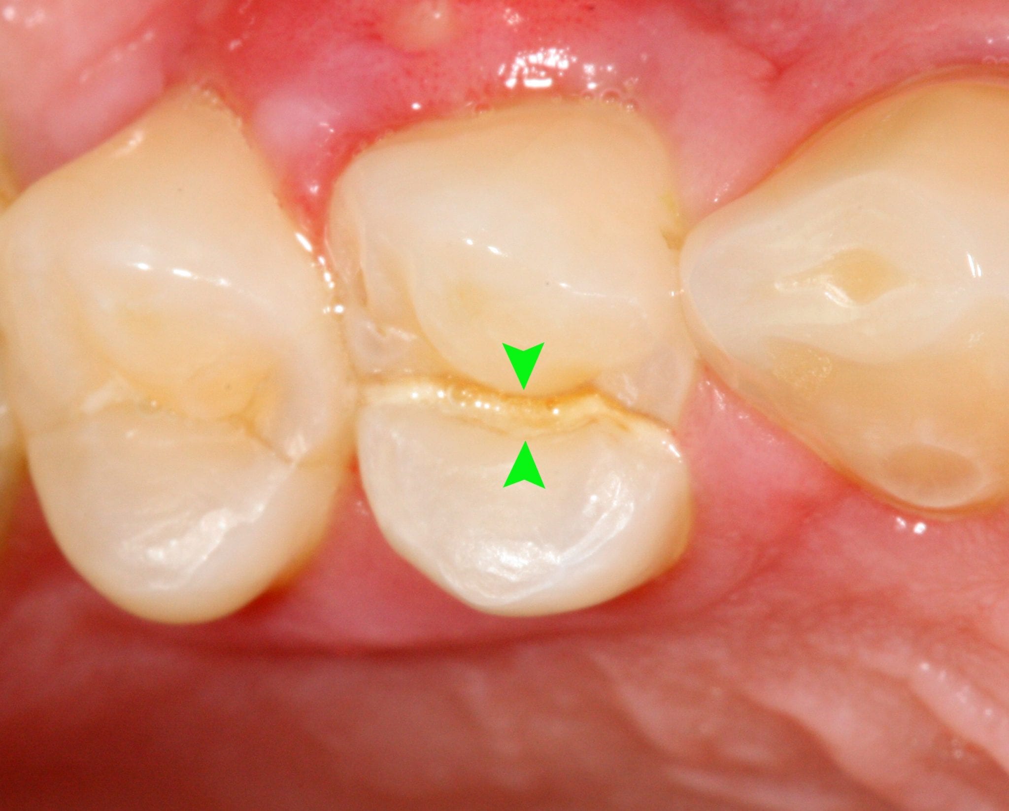 teeth translucent cracking