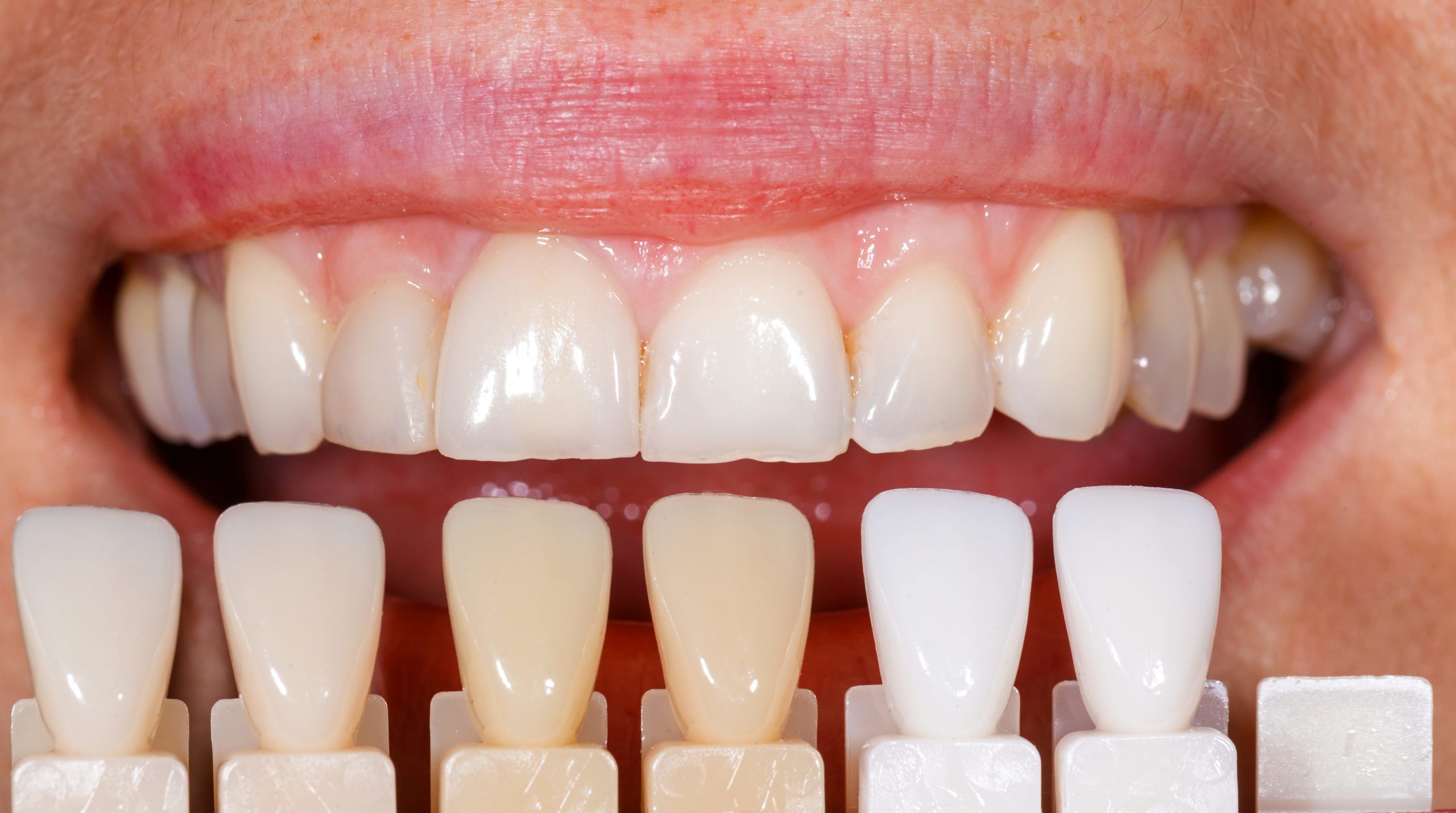 What Makes Someone A Good Candidate For Dental Veneers 